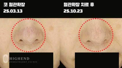 딸기코라 불리는 코 끝 혈관확장 치료 사례