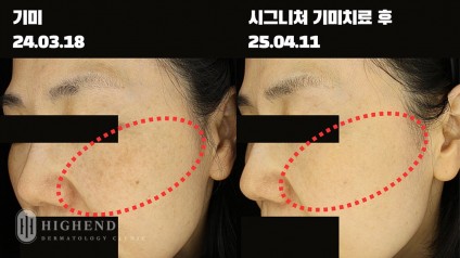 잘못된 치료로 인한 기미 악화 개선 케이스
