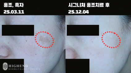 홍조동반 흑자 40대 여성 레이저 병합 치료