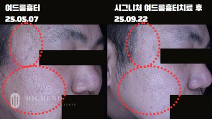 40대 남성심한 위축성 흉터와 롤링성 흉터 치료 사례