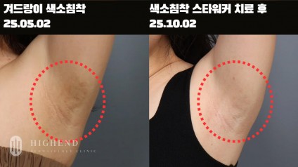 겨드랑이 색소침착 레이저 치료 경과