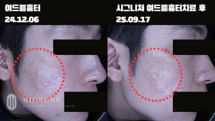 30대 남성 여드름 패인 흉터 치료