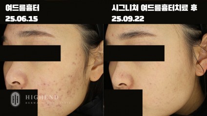 여드름 붉은 자국 및 파인 흉터 병합 치료 사례