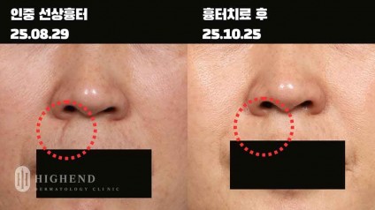 인중 선상 흉터 치료 사례